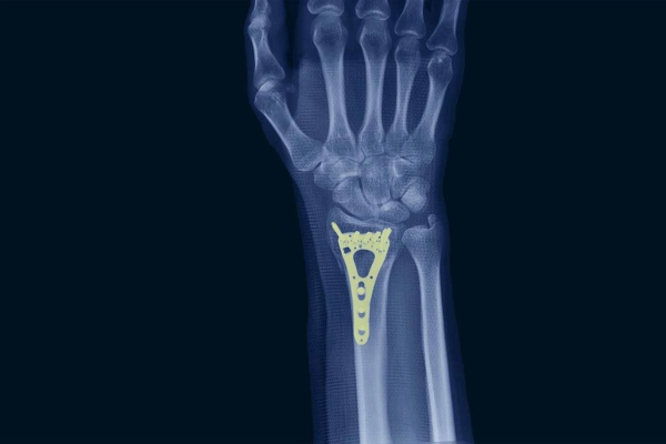 X-ray of a hand showing an osteosynthesis plate